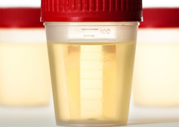 La importancia de mantener una orina saludable