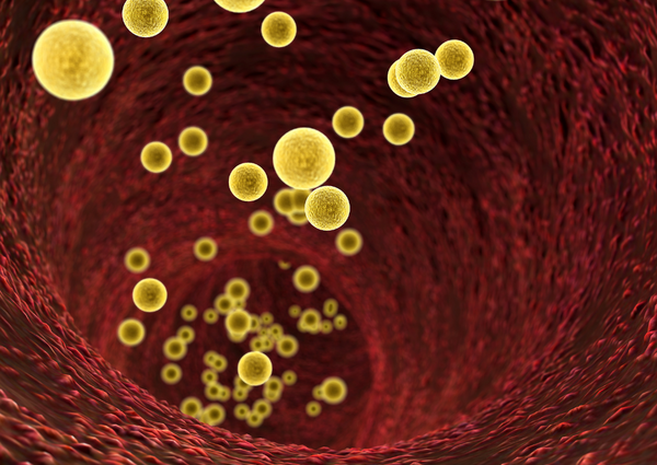 Fosfolípidos en Conjunción con el Láser Intravenoso: Un Avance Revolucionario en el Tratamiento del Colesterol y la Aterosclerosis.